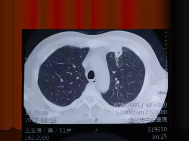 【PPT】肺炎克雷白杆菌肺炎影像学表现