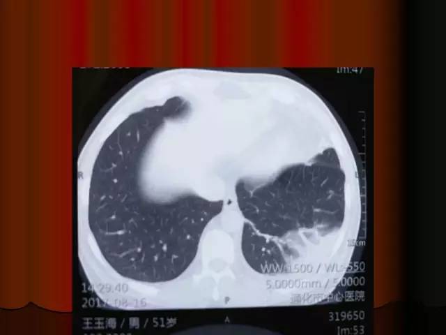 【PPT】肺炎克雷白杆菌肺炎影像学表现