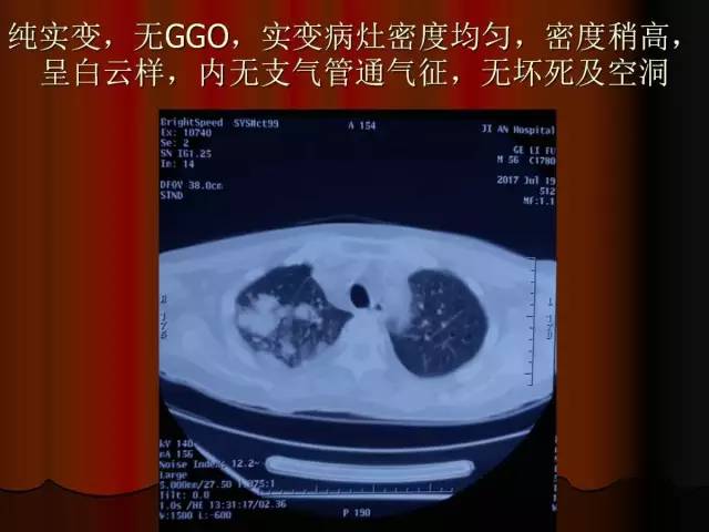 【PPT】肺炎克雷白杆菌肺炎影像学表现