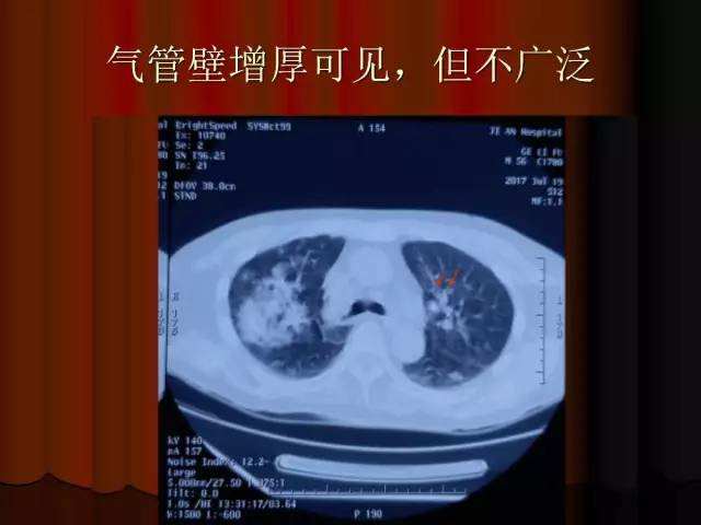 【PPT】肺炎克雷白杆菌肺炎影像学表现