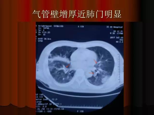 【PPT】肺炎克雷白杆菌肺炎影像学表现