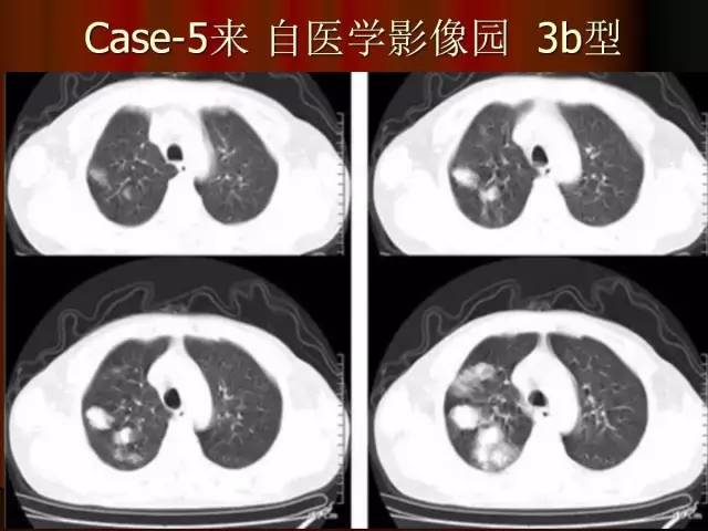 【PPT】肺炎克雷白杆菌肺炎影像学表现
