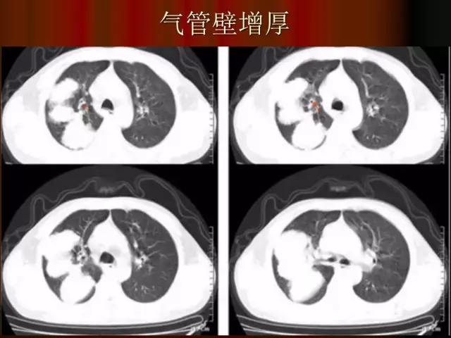 【PPT】肺炎克雷白杆菌肺炎影像学表现
