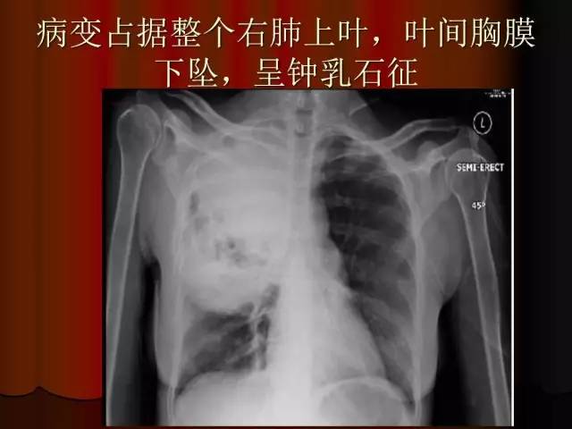 【PPT】肺炎克雷白杆菌肺炎影像学表现