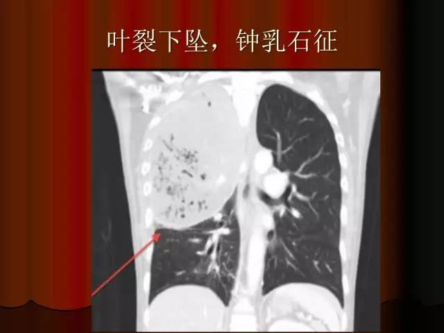 【PPT】肺炎克雷白杆菌肺炎影像学表现