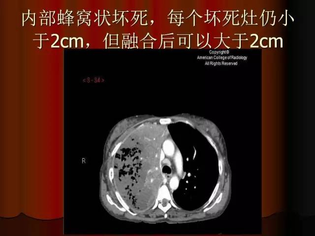 【PPT】肺炎克雷白杆菌肺炎影像学表现