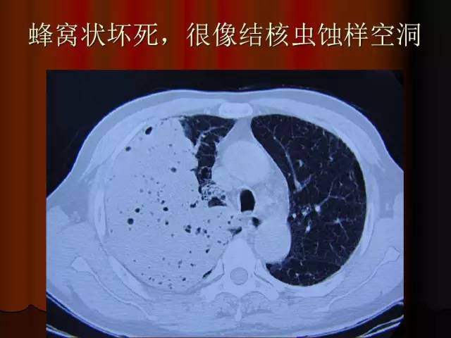 【PPT】肺炎克雷白杆菌肺炎影像学表现