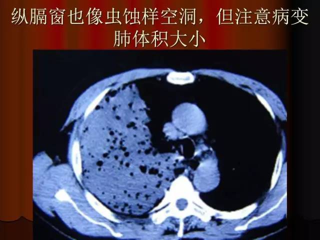 【PPT】肺炎克雷白杆菌肺炎影像学表现
