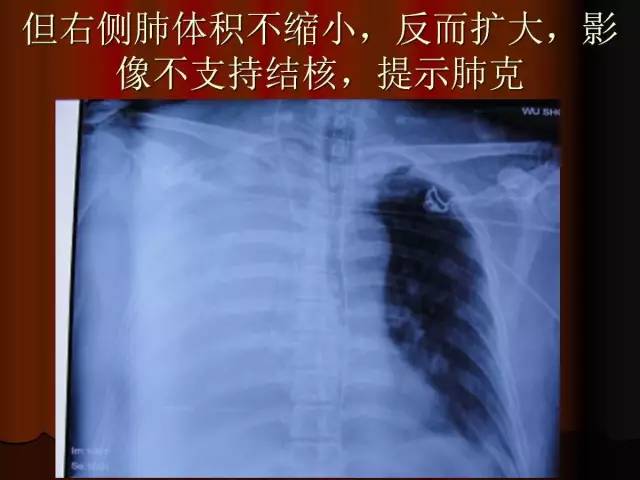 【PPT】肺炎克雷白杆菌肺炎影像学表现
