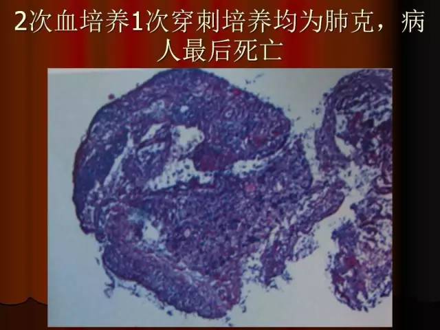 【PPT】肺炎克雷白杆菌肺炎影像学表现