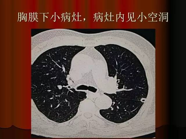 【PPT】肺炎克雷白杆菌肺炎影像学表现