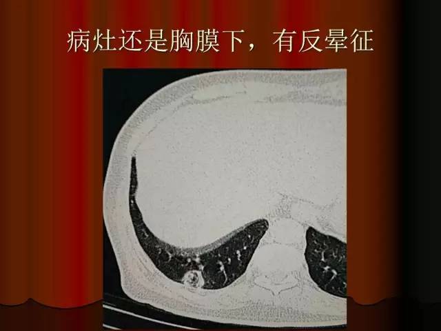 【PPT】肺炎克雷白杆菌肺炎影像学表现