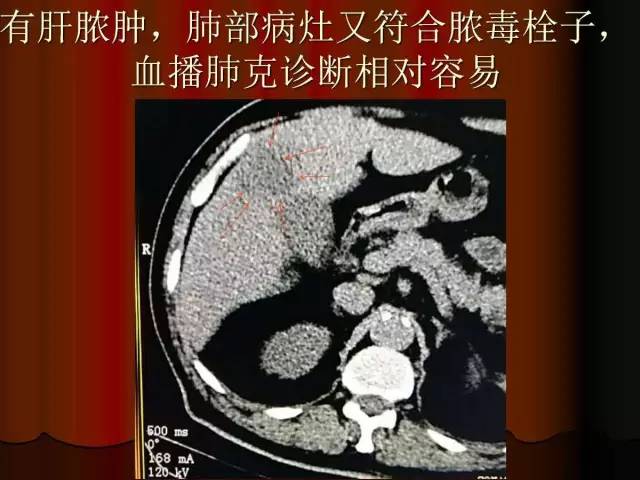 【PPT】肺炎克雷白杆菌肺炎影像学表现