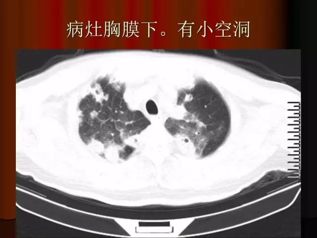 【PPT】肺炎克雷白杆菌肺炎影像学表现