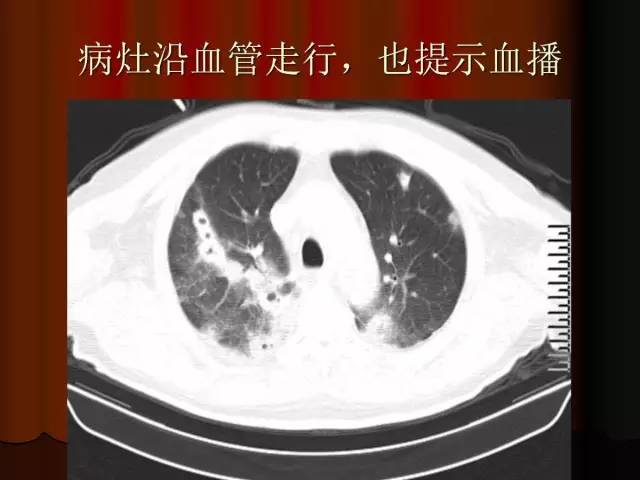 【PPT】肺炎克雷白杆菌肺炎影像学表现