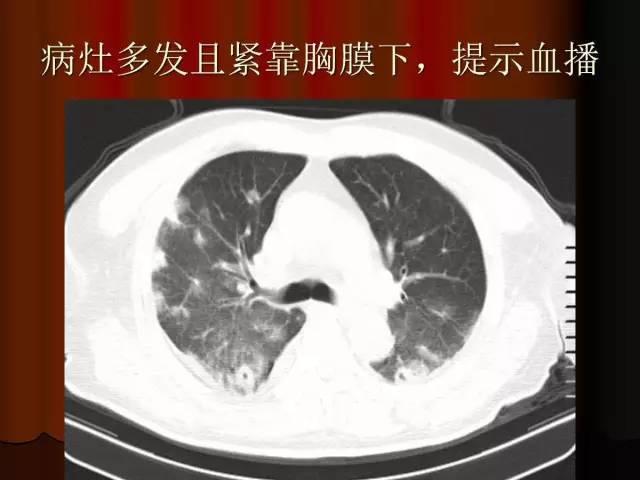 【PPT】肺炎克雷白杆菌肺炎影像学表现