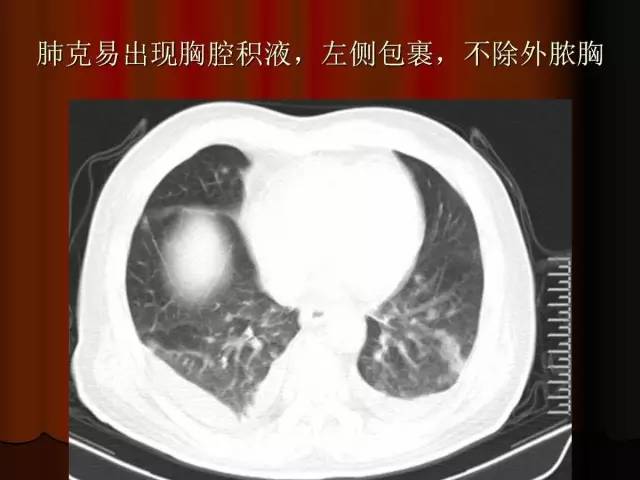 【PPT】肺炎克雷白杆菌肺炎影像学表现