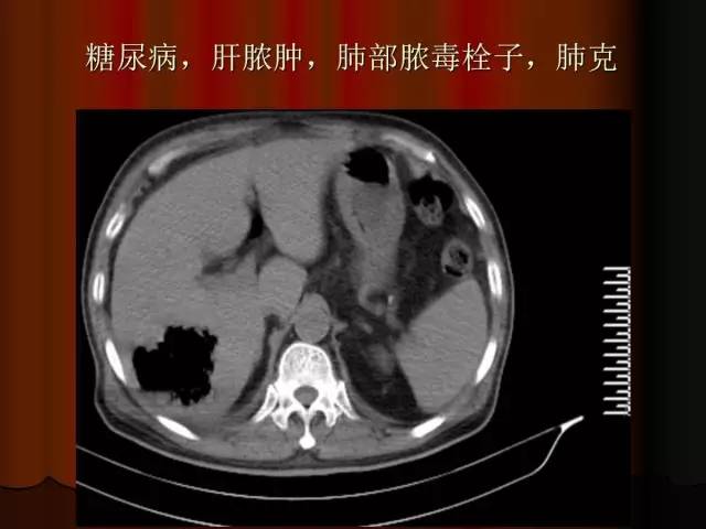 【PPT】肺炎克雷白杆菌肺炎影像学表现