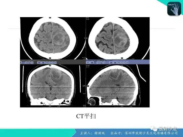 【病例】纤维型脑膜瘤1例CT及MR影像表现
