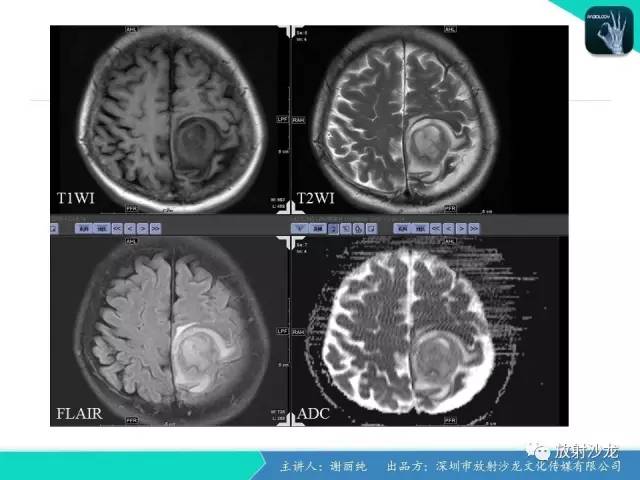 【病例】纤维型脑膜瘤1例CT及MR影像表现