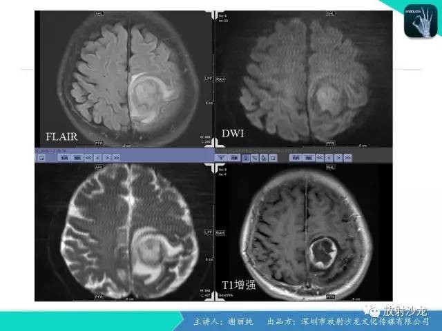 【病例】纤维型脑膜瘤1例CT及MR影像表现