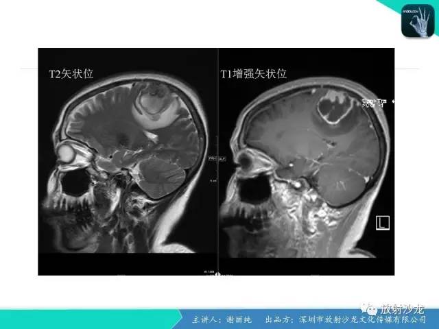 【病例】纤维型脑膜瘤1例CT及MR影像表现