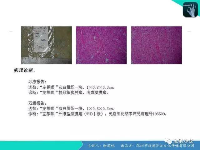 【病例】纤维型脑膜瘤1例CT及MR影像表现