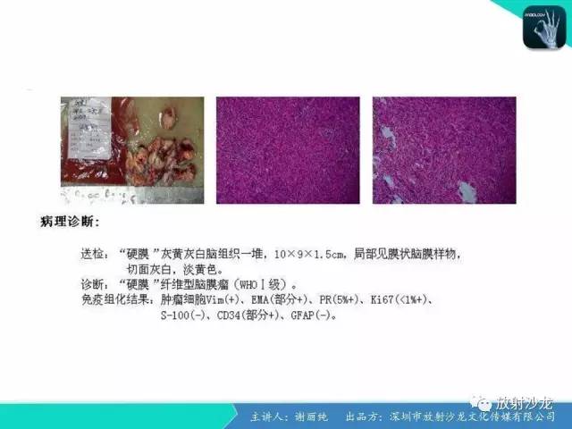 【病例】纤维型脑膜瘤1例CT及MR影像表现