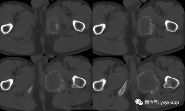 【病例】左耻坐骨非骨化性纤维瘤1例 【病例】左耻坐骨非骨化性纤维瘤1例