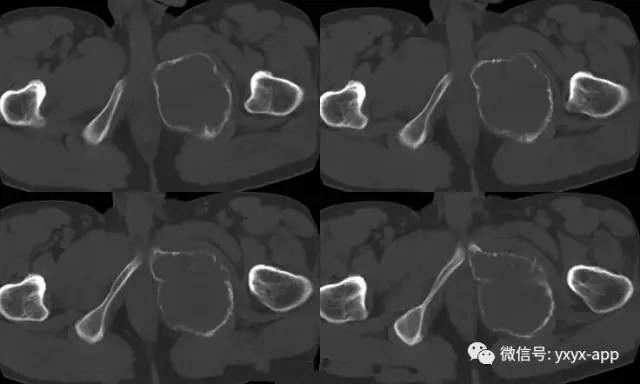 【病例】左耻坐骨非骨化性纤维瘤1例 【病例】左耻坐骨非骨化性纤维瘤1例