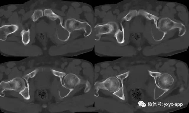 【病例】左耻坐骨非骨化性纤维瘤1例 【病例】左耻坐骨非骨化性纤维瘤1例