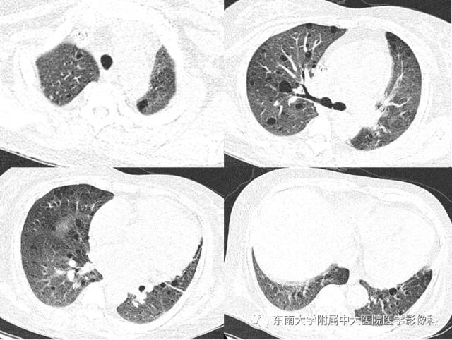 【病例】结节性硬化伴肺淋巴管肌瘤病1例