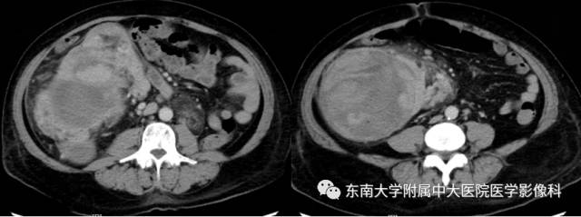 【病例】结节性硬化伴肺淋巴管肌瘤病1例