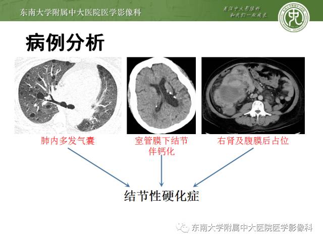 【病例】结节性硬化伴肺淋巴管肌瘤病1例