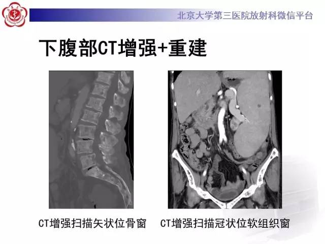 【病例】(脊柱)骨髓纤维化1例CT及MR影像表现