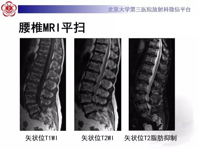 【病例】(脊柱)骨髓纤维化1例CT及MR影像表现
