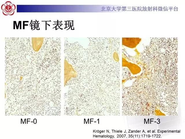 【病例】(脊柱)骨髓纤维化1例CT及MR影像表现