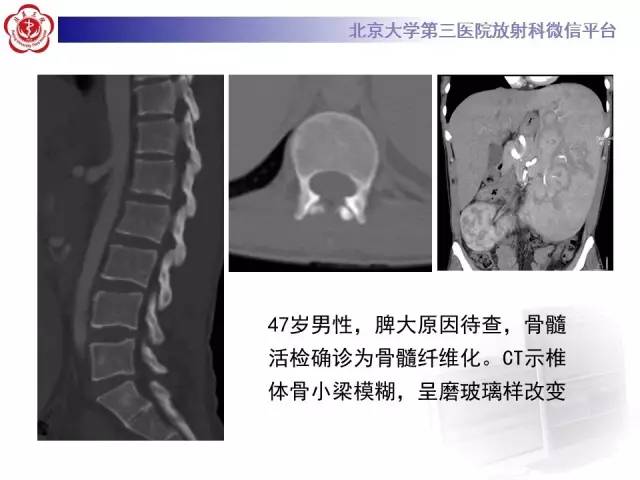 【病例】(脊柱)骨髓纤维化1例CT及MR影像表现