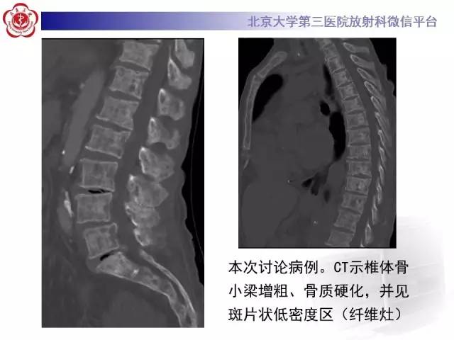 【病例】(脊柱)骨髓纤维化1例CT及MR影像表现