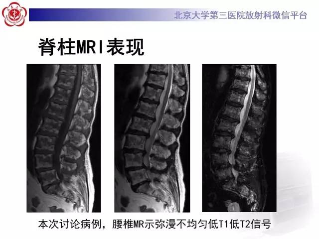 【病例】(脊柱)骨髓纤维化1例CT及MR影像表现