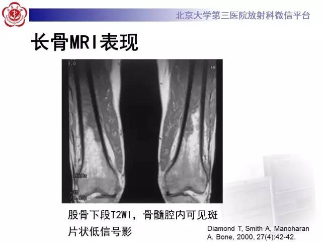 【病例】(脊柱)骨髓纤维化1例CT及MR影像表现