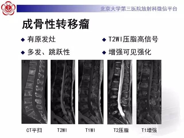 【病例】(脊柱)骨髓纤维化1例CT及MR影像表现