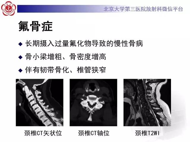 【病例】(脊柱)骨髓纤维化1例CT及MR影像表现