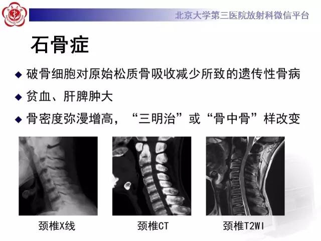 【病例】(脊柱)骨髓纤维化1例CT及MR影像表现