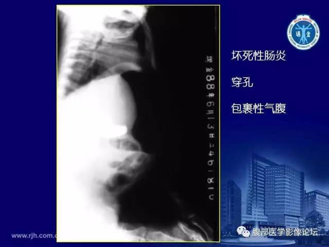 【PPT】急腹症