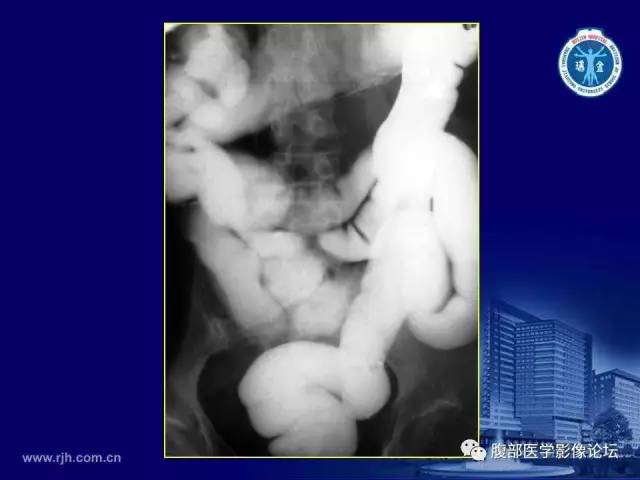 【PPT】急腹症
