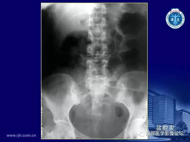 【PPT】急腹症