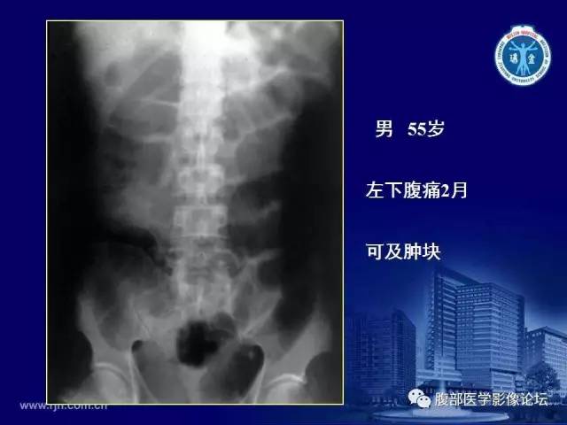 【PPT】急腹症