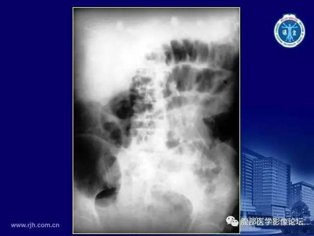 【PPT】急腹症