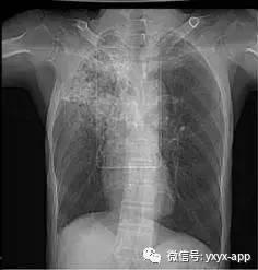 【病例】肺真菌病1例CT影像表现 【病例】肺真菌病1例CT影像表现